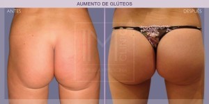 Before and after pictures of buttock augmentation treatment